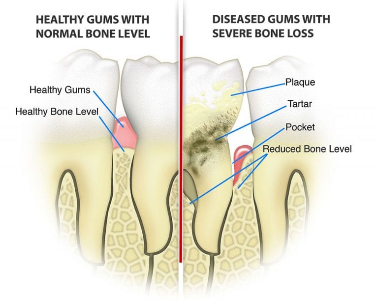What are the signs and causes of periodontal disease